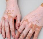 vitiligo treatment in Noida